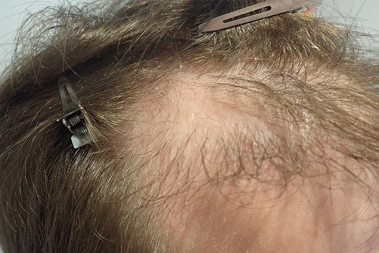 Haartransplantation vor Behandlung