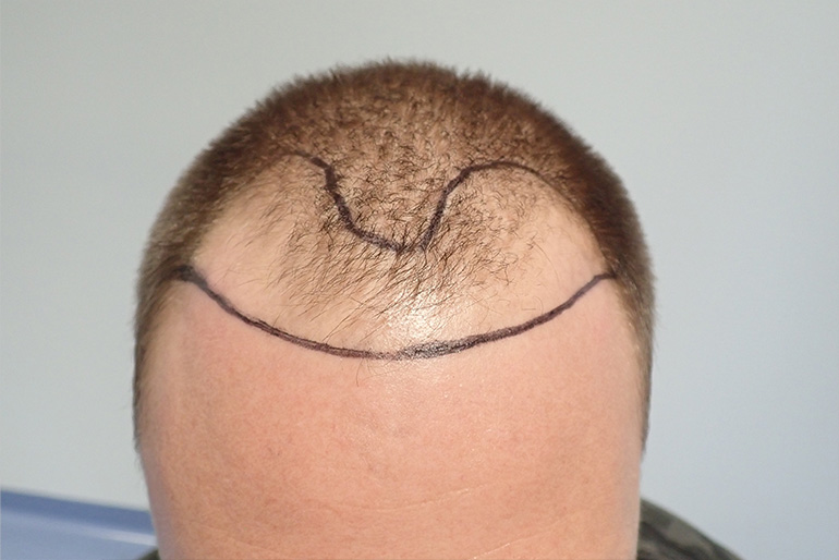 Vorher Haartransplantation