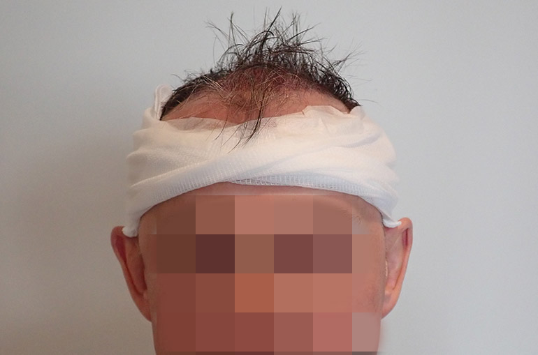 Mann Haartransplantation nach der Behandlung