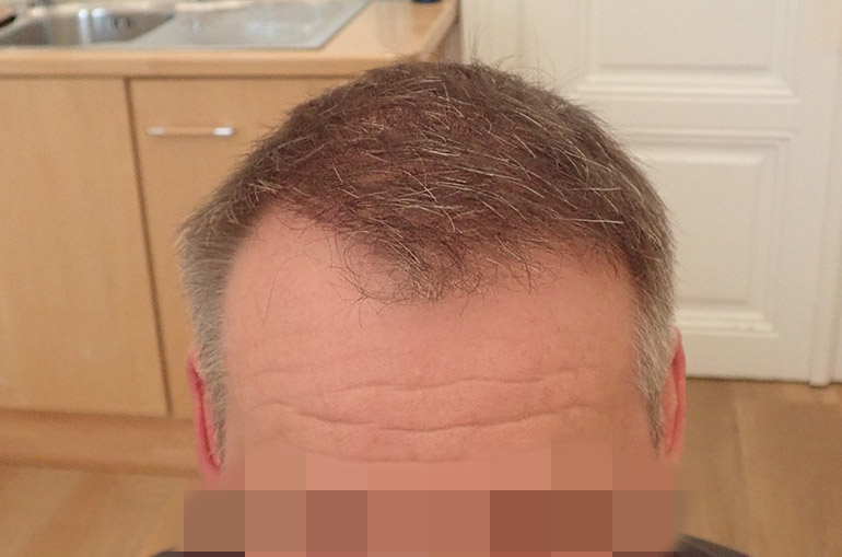 Mann Haartransplantation Ergebnis
