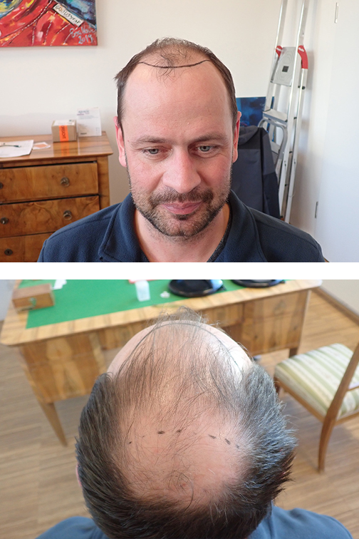 Haartransplantation Haarlinie vorher