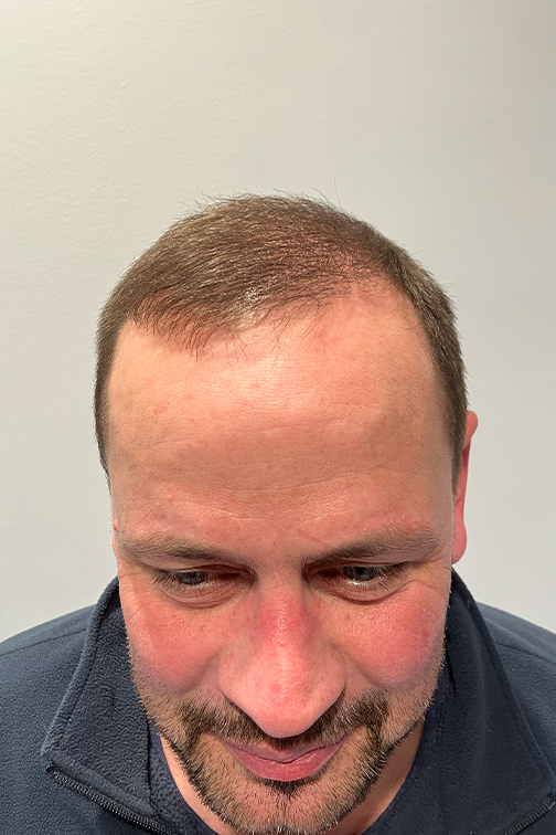 Haartransplantation Haarlinie nacher