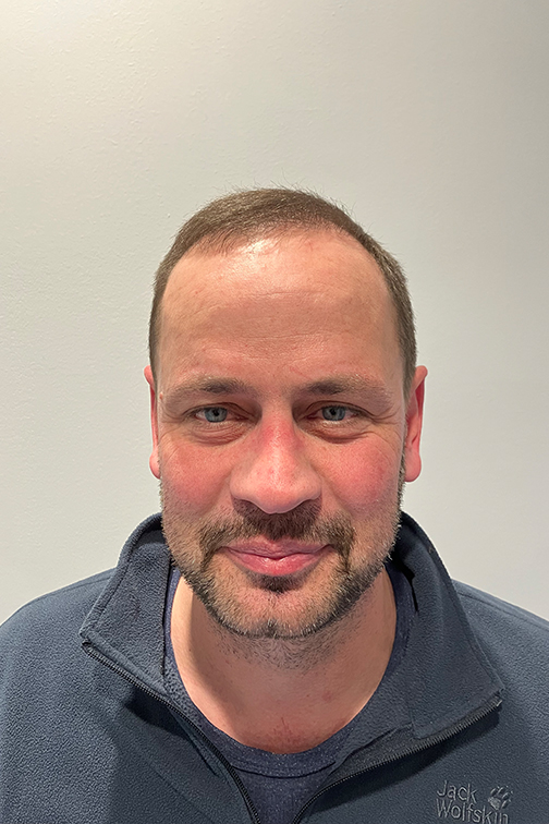 Haartransplantation Behandlungsergebnis