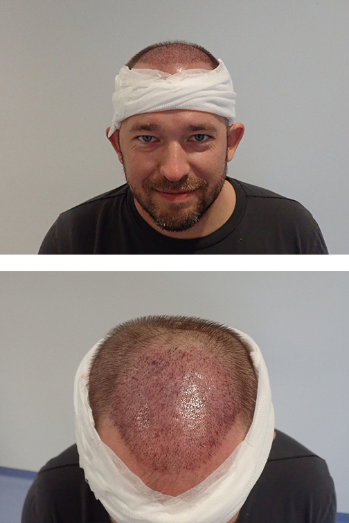 Haartransplantation Haarlinie nacher