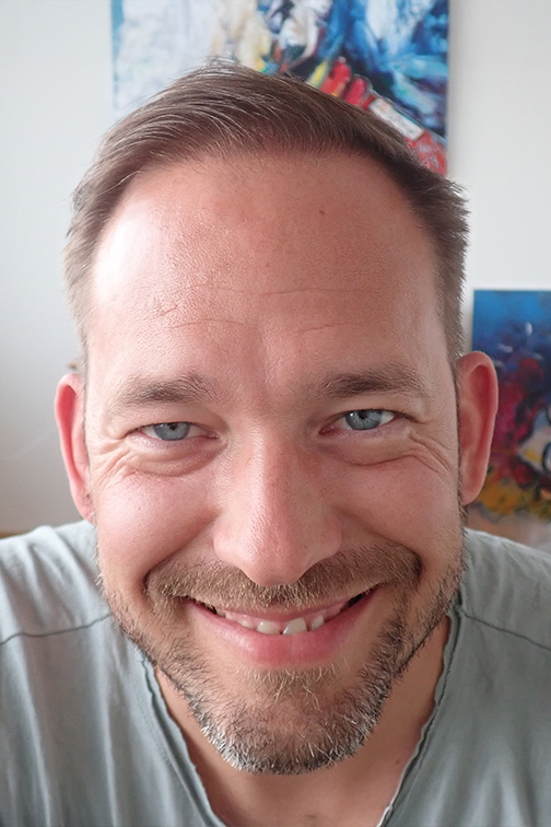 Haartransplantation Behandlungsergebnis