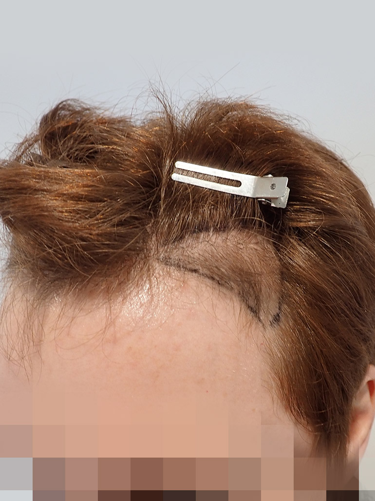 Haartransplantation Frau Vorher
